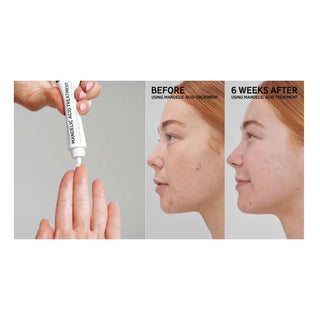 Mandelic Acid Treatment
