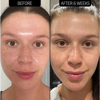 Excess Oil Solution